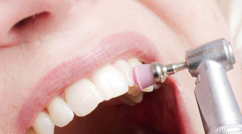 PROFILAXIS HIGIENE BUCO DENTAL